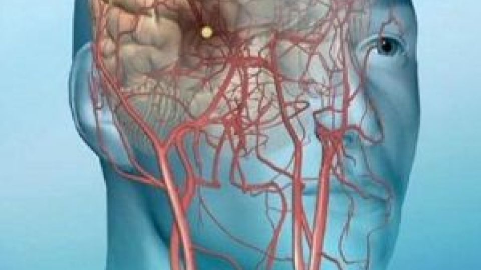 روشی نوین برای رفع لختههای مغزی بزرگ/ لزوم تحت پوشش بیمه قرار گرفتن روش مداخلهای روشی نوین برای رفع لختههای مغزی بزرگ/ لزوم تحت پوشش بیمه قرار گرفتن روش مداخلهای