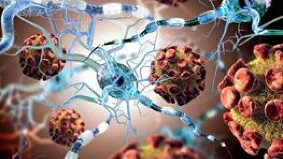 تحولی انقلابی در درمان اماس با پیوند سلولهای بنیادی خونساز تحولی انقلابی در درمان اماس با پیوند سلولهای بنیادی خونساز