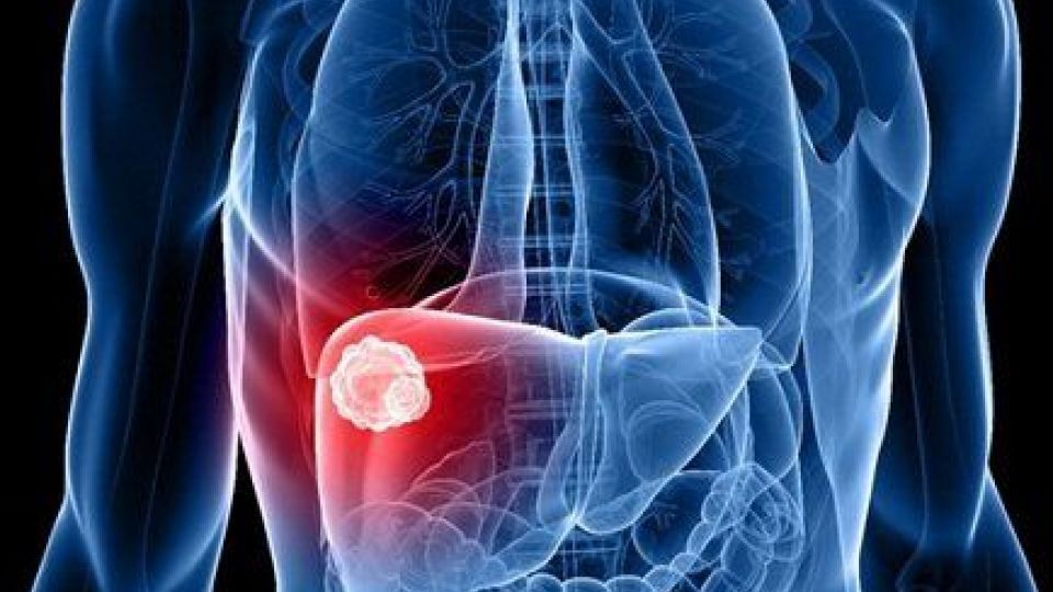 چگونه از بروز سرطان کبد پیشگیری کنیم؟ چگونه از بروز سرطان کبد پیشگیری کنیم؟