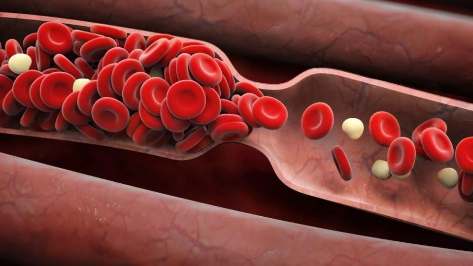 چه عواملی در ایجاد لخته خون نقش دارند؟ چه عواملی در ایجاد لخته خون نقش دارند؟