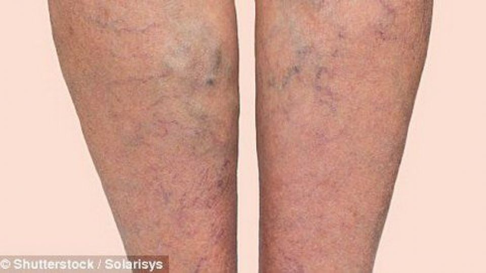 راهکارهای طبیعی برای درمان واریس راهکارهای طبیعی برای درمان واریس