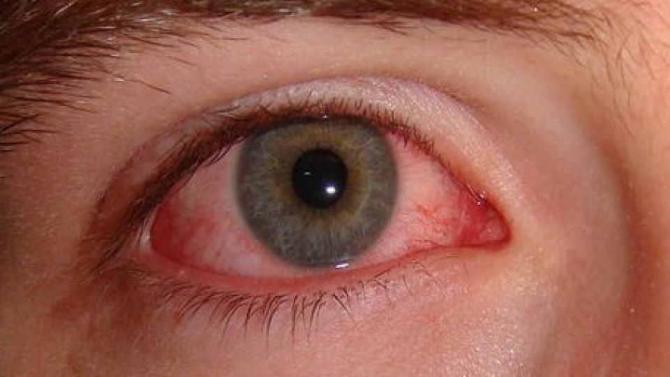 علل سوزش چشمها و درمان آن علل سوزش چشمها و درمان آن