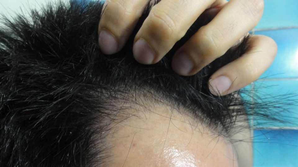 چرا کاهش وزن موجب ریزش مو میشود؟ چرا کاهش وزن موجب ریزش مو میشود؟