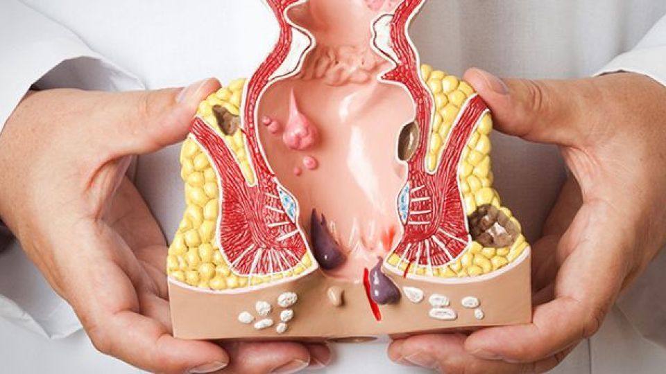 علائم و راه درمان سرطان رکتوم علائم و راه درمان سرطان رکتوم