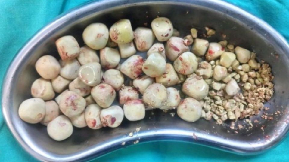 خارج کردن ۵۰ سنگ از مثانه یک بیمار خارج کردن ۵۰ سنگ از مثانه یک بیمار