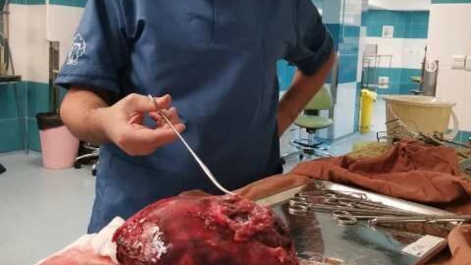 خارج کردن توده20سانتیمتری از ریه جوان یزدی