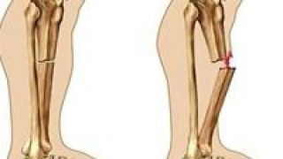 مهم ترین دلیل پوکی استخوان