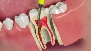هرآنچه باید در خصوص عصب‌کشی دندان‌ها بدانید