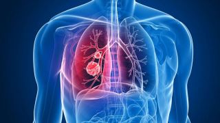 علائم بیماری ریوی چیست؟