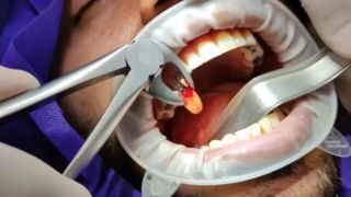 پوسیدگی، جرم گیری و ساخت دندان تحت پوشش بیمه قرار می‌گیرند