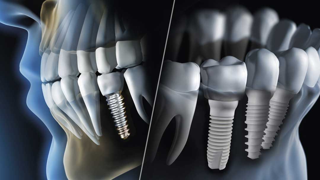 ایمپلنت دندان