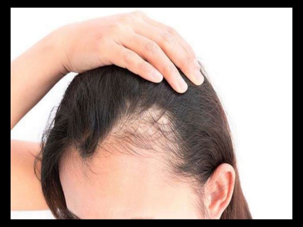 دلایل ریزش مو هورمونی