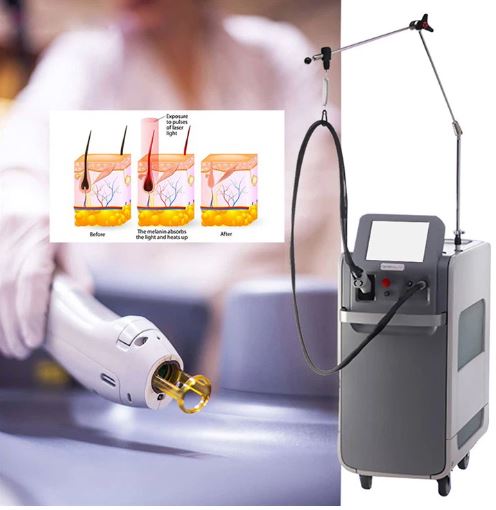 دستگاه لیزر کندلا 