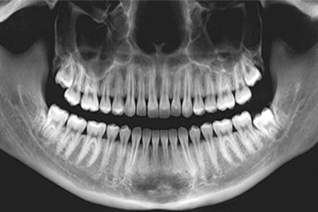 آموزش خواندن عکس دندان 