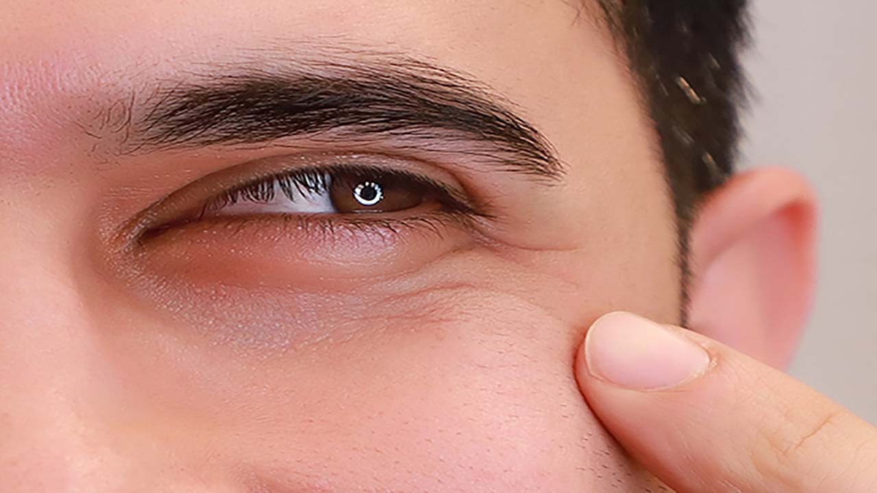 درمان خطوط پنجه کلاغی