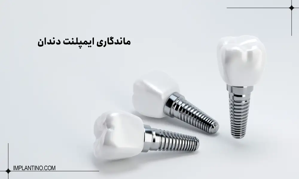 ایمپلنت های دندان و ماندگاری آن های برای کاشت