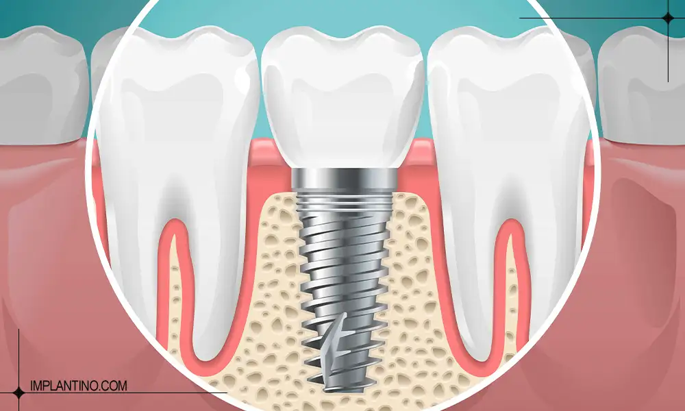 عکی ایمپلنت دندان کاشت شده