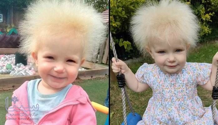 سندروم موی انیشتین