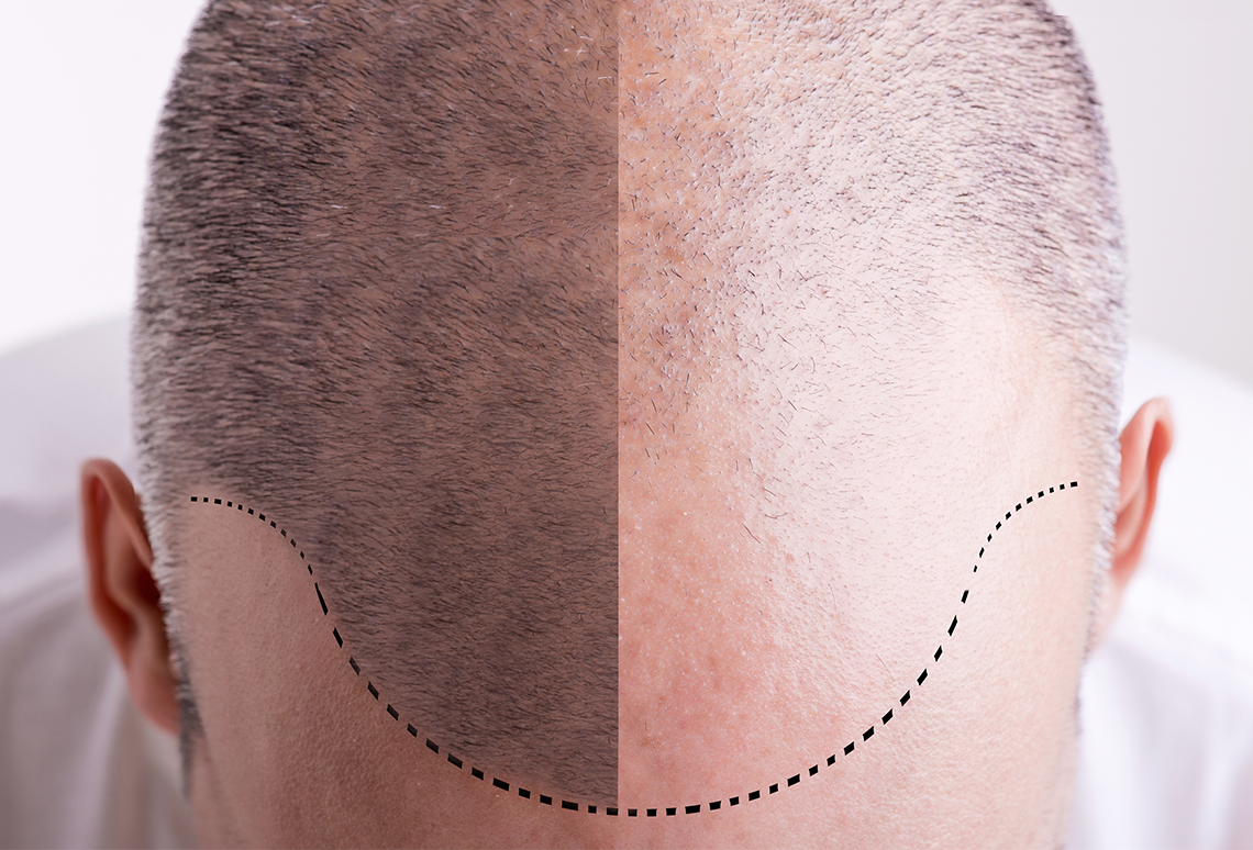 پیشرفته ترین روش کاشت مو