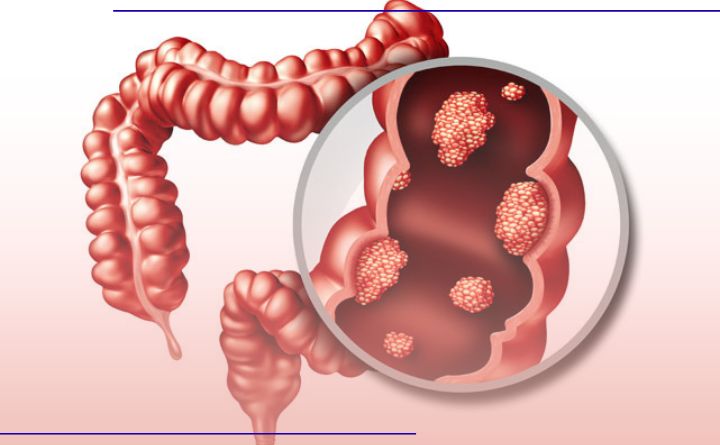 سرطان کولورکتال چیست؟