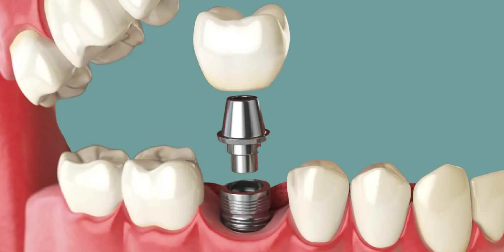 بررسی مراحل کاشت ایمپلنت دندان