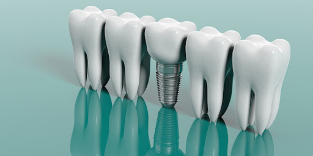 بررسی مراحل کاشت ایمپلنت دندان 