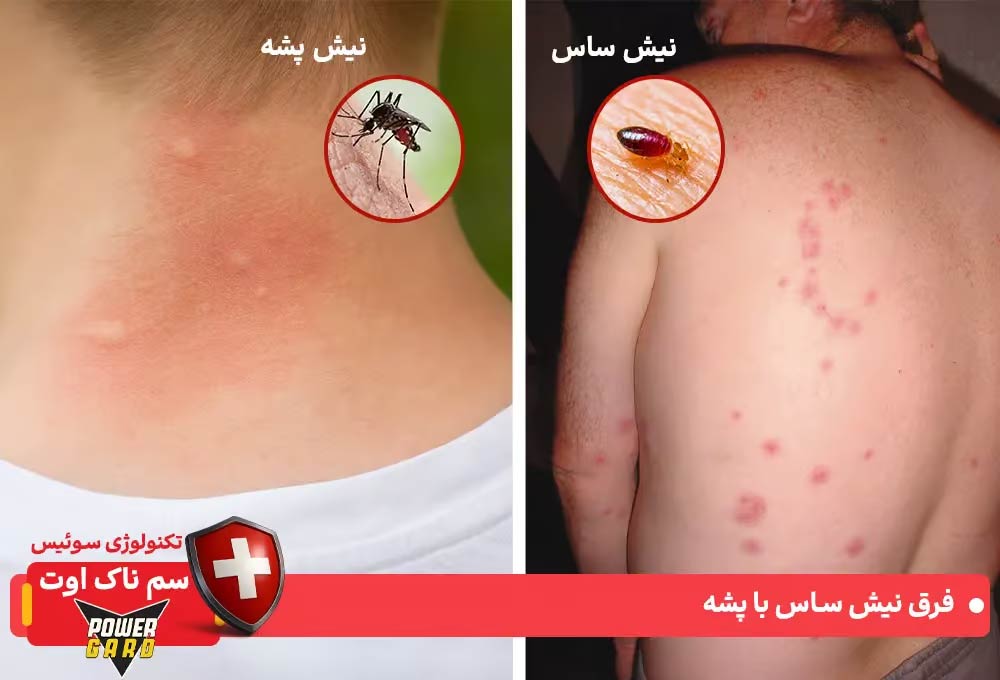 نیش ساس تختخواب چه شکلی است؟ و فرق نیش ساس و پشه