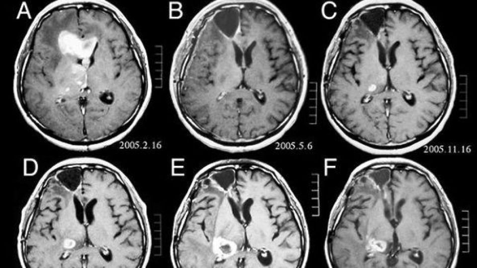 سی تی اسکن موجب افزایش ریسک تومور مغزی می شود؟ سی تی اسکن موجب افزایش ریسک تومور مغزی می شود؟