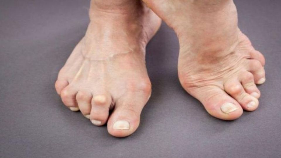 نقرس، بیماری شایع مردان + علایم نقرس، بیماری شایع مردان + علایم