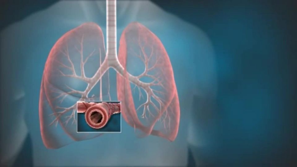 تنگی نفس و سرفههای طولانی را جدی بگیرید تنگی نفس و سرفههای طولانی را جدی بگیرید