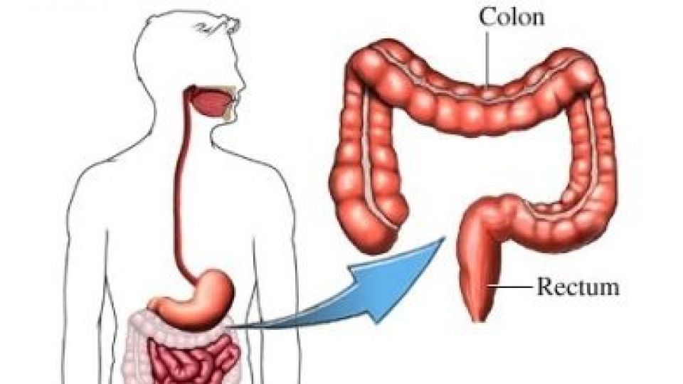 افزایش خطر ابتلا به دیابت با عمل کولکتومی افزایش خطر ابتلا به دیابت با عمل کولکتومی