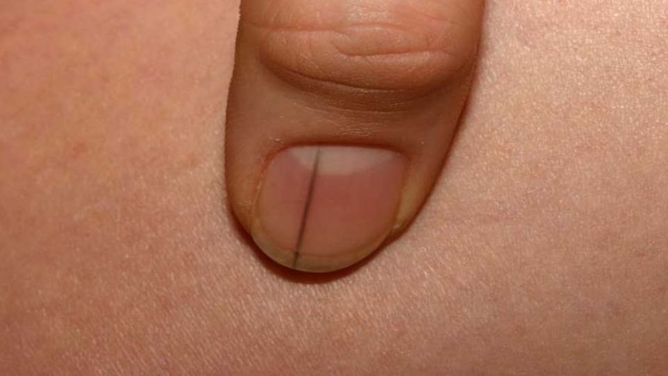 خطوط مشکی ناخن نشانه چیست؟ خطوط مشکی ناخن نشانه چیست؟