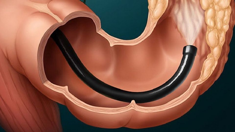 کشف دو علامت کلیدی ابتلا به سرطان روده