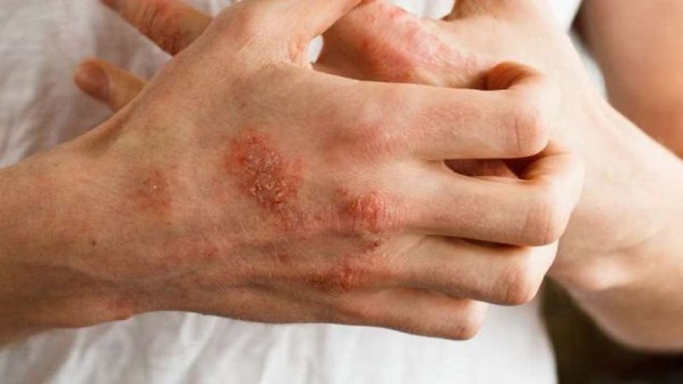 راهکار‌های طبیعی برای درمان عفونت‌های پوستی