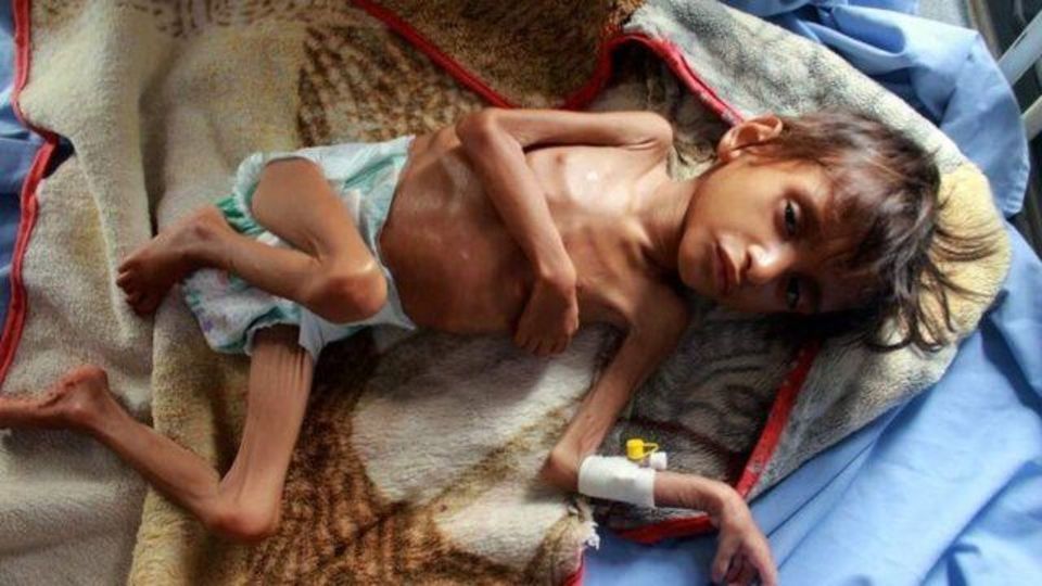 هشدار برنامه جهانی غذا درباره سطح بی‌سابقه گرسنگی در یمن