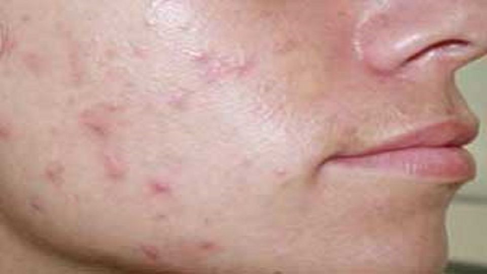 چند راهکار‌ ساده برای خلاصی از جوش صورت