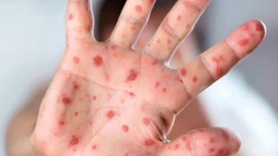 هشدار رئیس دانشگاه علوم پزشکی شهید بهشتی در خصوص بیماری سرخک