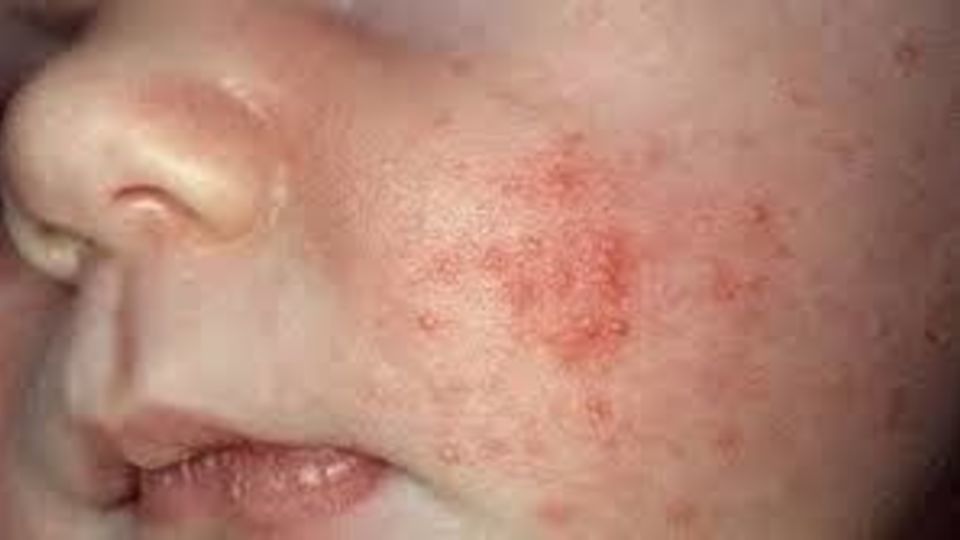 بیدارشدن سرخک از خواب زمستانی