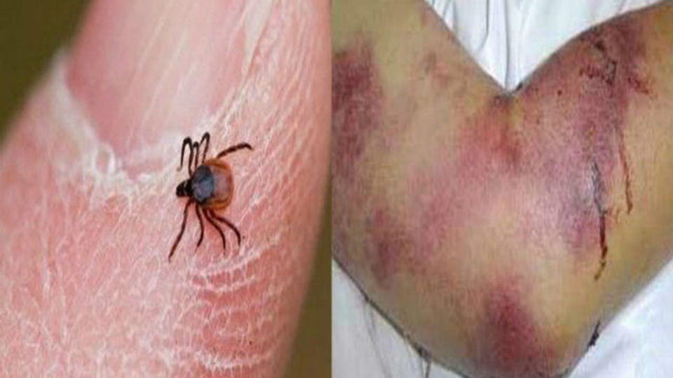 افزایش آمار ابتلا و فوت ناشی از تب کریمه کنگو افزایش آمار ابتلا و فوت ناشی از تب کریمه کنگو