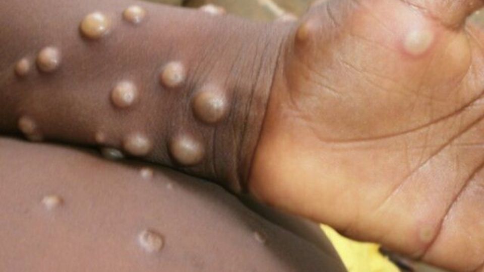 شباهت علائم آبله میمونی و آبله مرغان / نحوه نمونه گیری از افراد مشکوک به بیماری