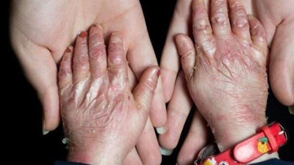 ۲۵ بیماری جدید به فهرست بیماریهای نادر کشور اضافه شد ۲۵ بیماری جدید به فهرست بیماریهای نادر کشور اضافه شد