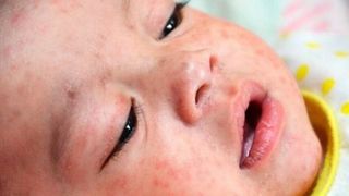 آخرین وضعیت «سرخک» در ایران / تدارک واکسیناسیون سریع‌تر اتباع خارجی