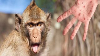 احتمال افزایش موارد ابتلا به آبله میمونی در تابستان