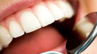 فرق کامپوزیت و لمینت دندان در چیست؟