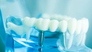 ایمپلنت و لمینت دندان چه فرقی با هم دارند؟