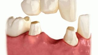 ایمپلنت دندان و بریج دندان چه فرقی با یکدیگر دارند؟