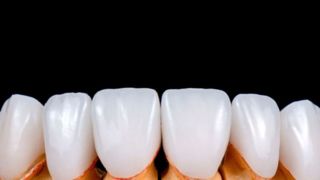 لمینت دندان با ۲۰ درصد تخفیف فقط تا پایان مرداد ماه