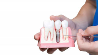 مهمترین مراقبت های قبل و بعد از ایمپلنت دندان