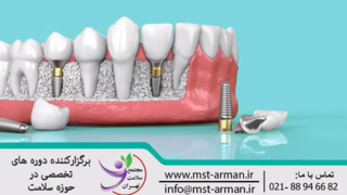 معرفی بهترین دوره ایمپلنت دندان در تهران