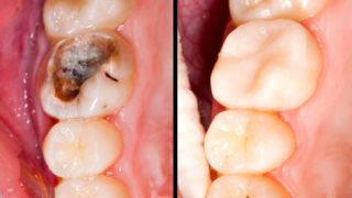 راحت‌ترین راه‌های پیشگیری از پوسیدگی دندان 
